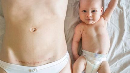 El paso por la cesárea puede dejar huellas emocionales.