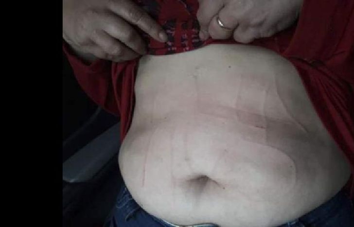 Le escribieron la panza con un punzón.