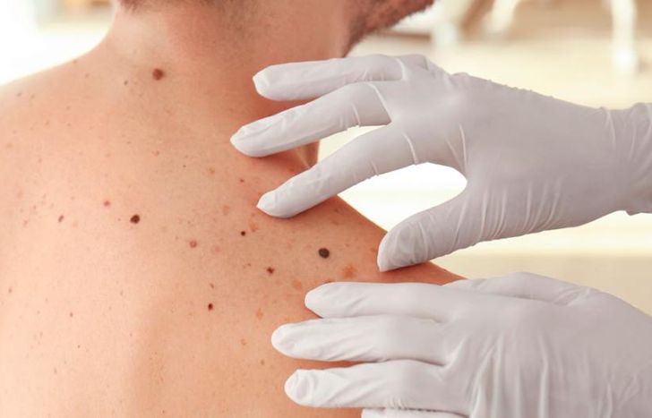 Control de manchas y lunares en la piel.