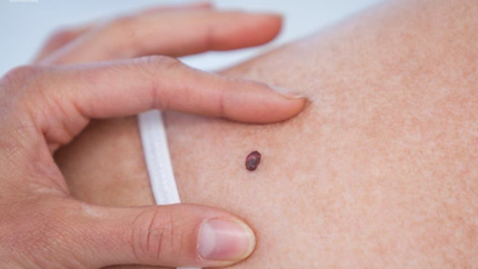 Harán chequeos dermatológicos y de lunares gratis en Lomas de Zamora