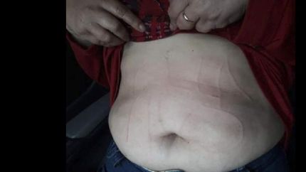 Le escribieron la panza con un punzón.