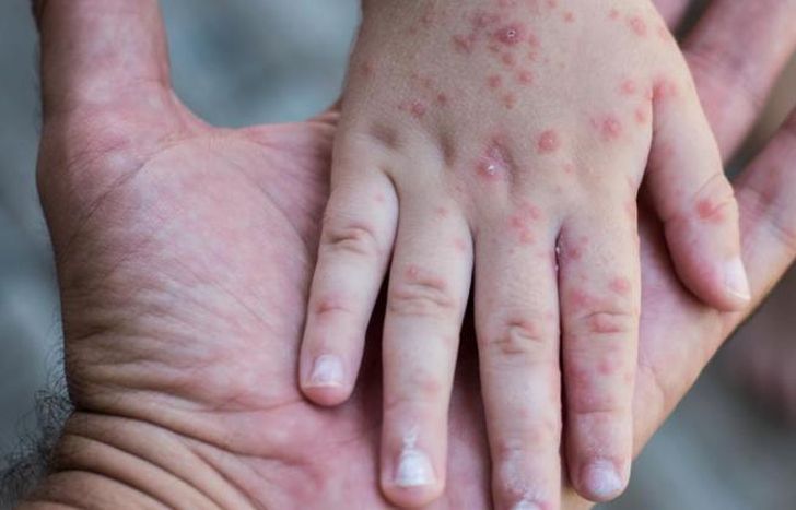 Boca, manos y pie afectan, por lo general, a menores de 5 años.