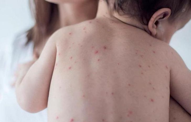 Inician campaña de vacunación contra sarampión, rubéola, paperas y polio.