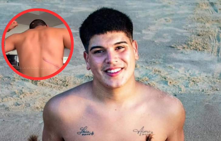 Thiago Medina accedió a mostrar las marcas que le dejaron en el cuerpo el accidente en moto.