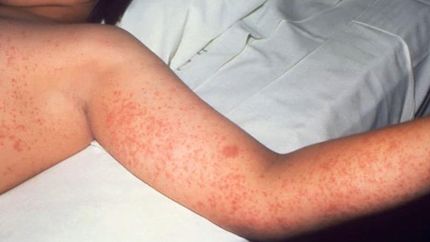 El sarampión es una enfermedad altamente contagiosa.