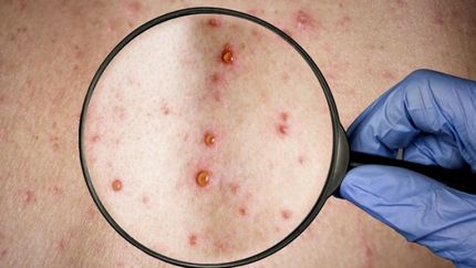 El Ministerio de Salud detalló una serie de recomendaciones luego de conocerse el primer caso sospechoso de viruela del mono en la Argentina.