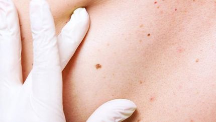 Control de manchas y lunares.