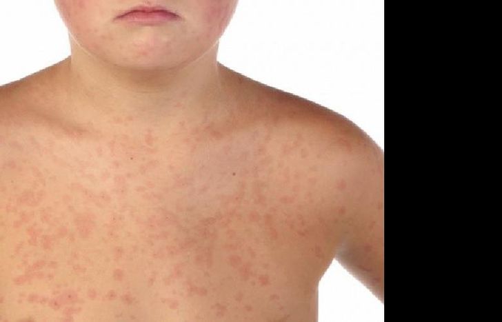 Son 14 en total los casos de Sarampión.