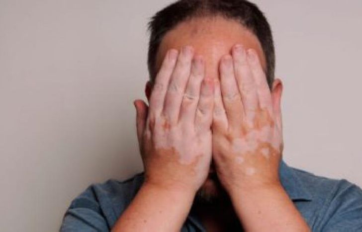 vitiligo