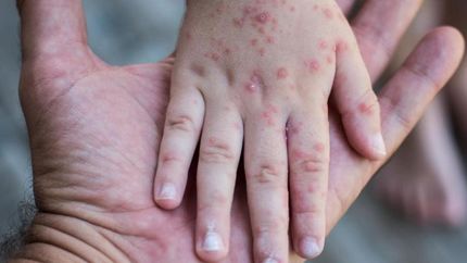 Boca, manos y pie afectan, por lo general, a menores de 5 años.