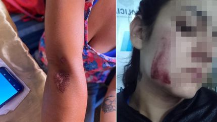 Las marcas de la golpiza en la denunciante.