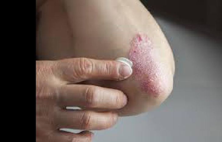 psoriasis