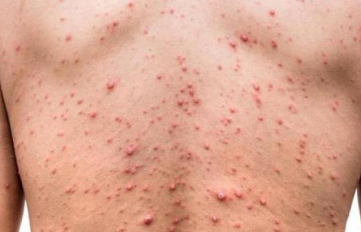 Detectaron el primer caso sospechoso de viruela del mono en la Argentina. Imagen ilustrativa.