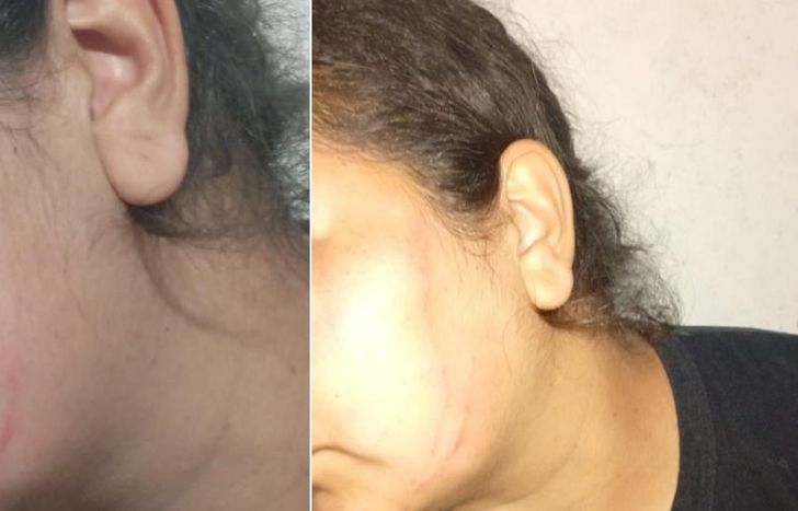 Las marcas en la víctima de uno de los ataques.