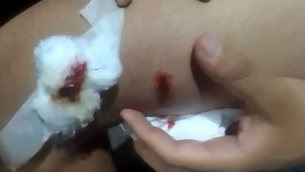 Un joven de Fiorito resultó herido por una bala perdida en Navidad. Un joven de Fiorito resultó herido por una bala perdida en Navidad.