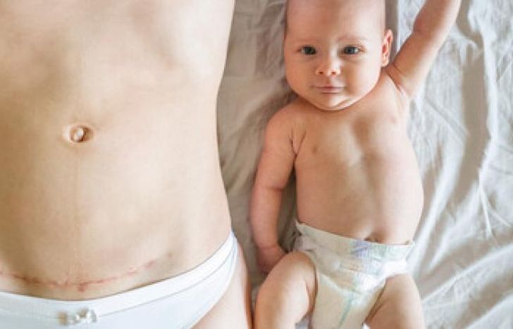 El paso por la cesárea puede dejar huellas emocionales.