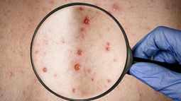 El Ministerio de Salud detalló una serie de recomendaciones luego de conocerse el primer caso sospechoso de viruela del mono en la Argentina.